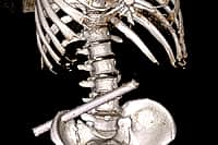 Новочебоксарские врачи извлекли из пациента 25 сантиметровую трубу.